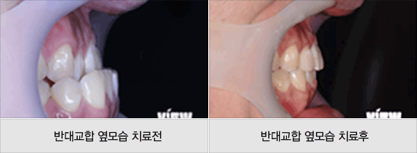 ¹Ý´ë±³ÇÕ ¿·¸ð½À Ä¡·áÀü ¹Ý´ë±³ÇÕ ¿·¸ð½À Ä¡·áÈÄ