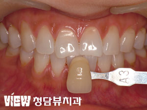 치아미백과 간단 앞니성형