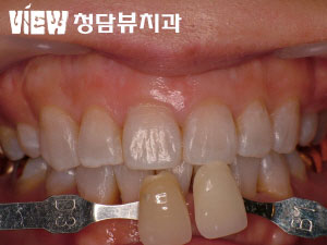 치아미백의 한계와 라미네이트 미백효과